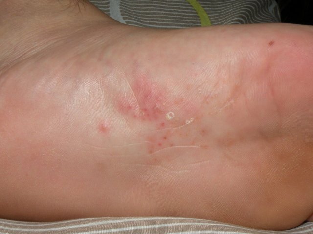 Micoza piciorului: Umflarea picioarelor - Cistita - prevenire si tratament