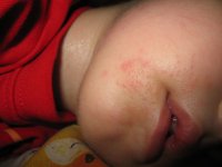 http://forum.anticonceptionale.ro/uploads/thumbs/10821_eczema_barbie2.jpg